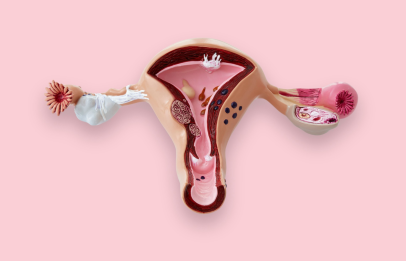 Cosa sono le cisti ovariche?