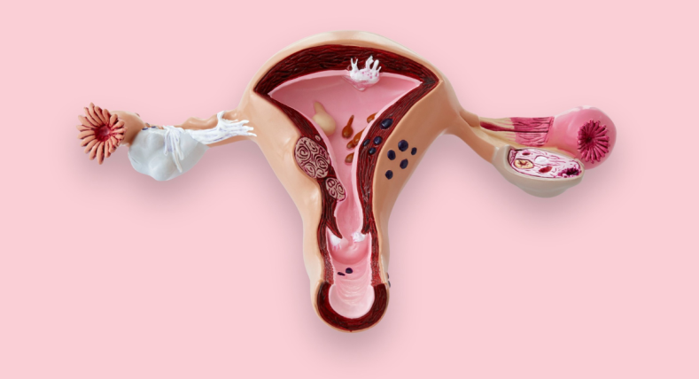 Cosa sono le cisti ovariche?